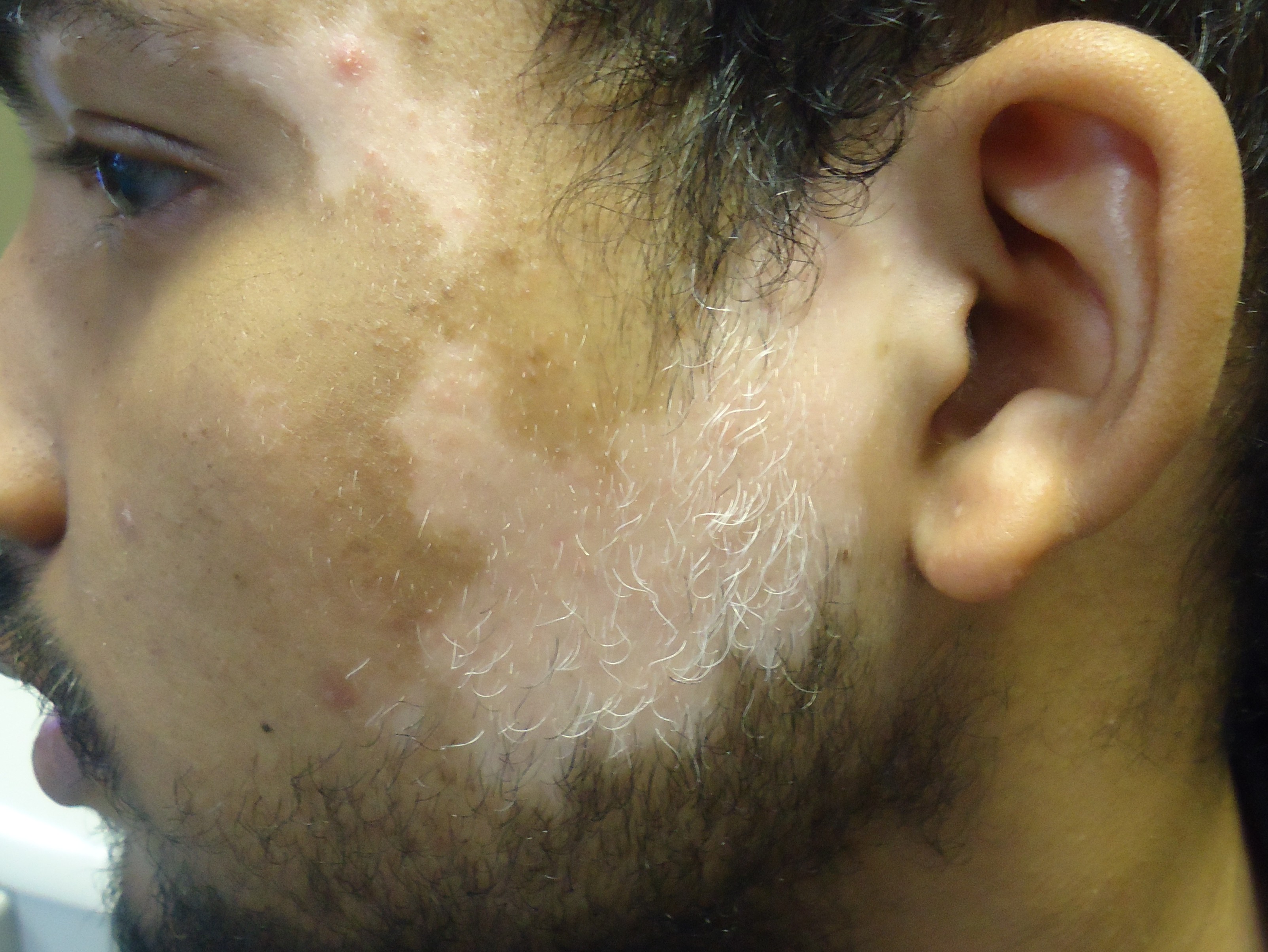 Psychosocial implications of Vitiligo - Lasermed: Laser Clinic & facial  rejuvenation