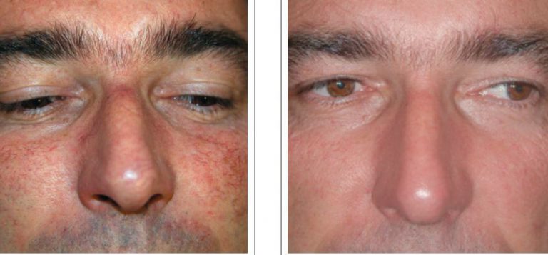 Treatment For Broken Blood Vessels Or Facial Capillaries Lasermed Laser Hair Removal Laser 