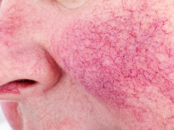 Manage rosacea effectively