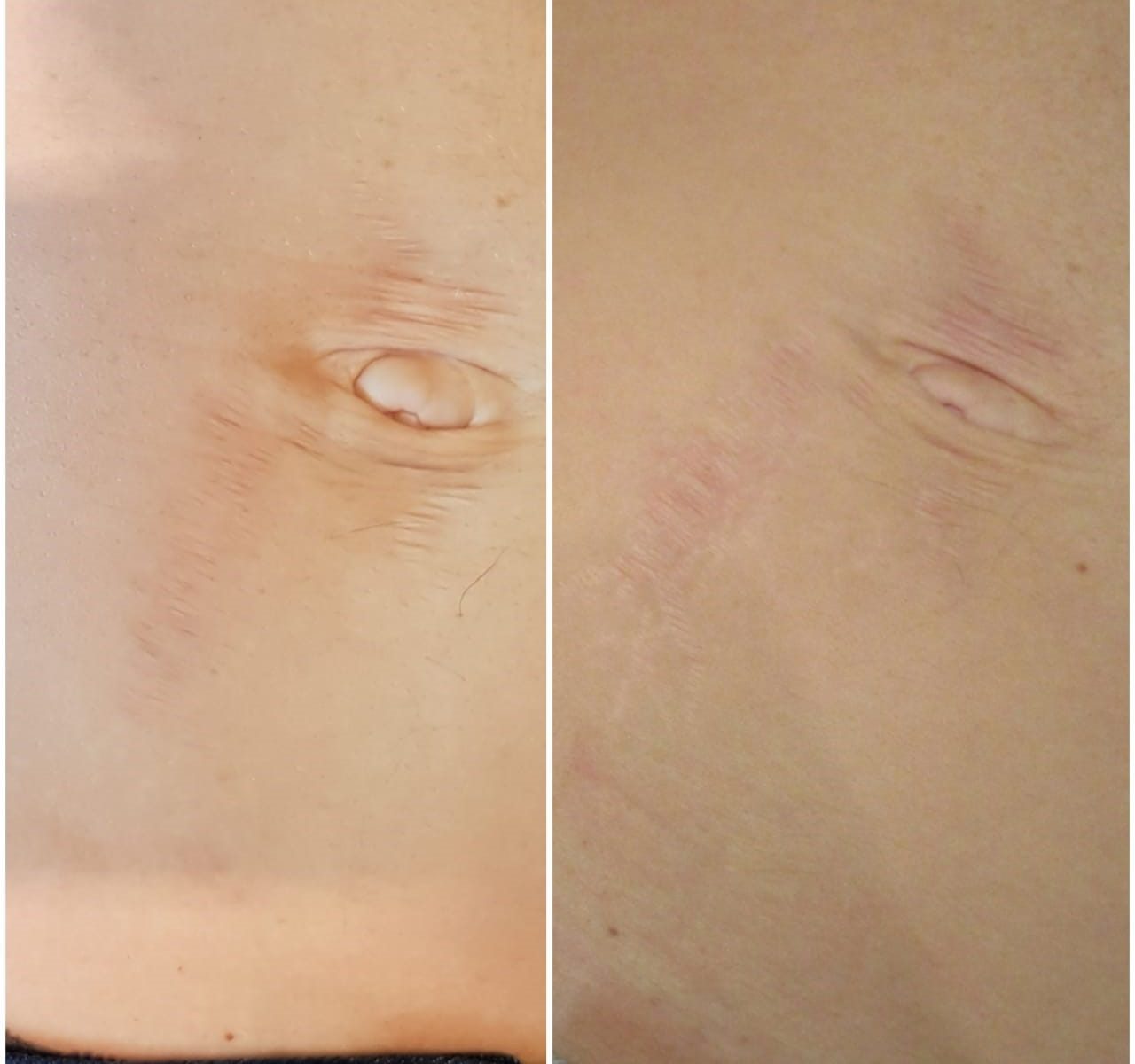 Stretchmarks before and after microneedling