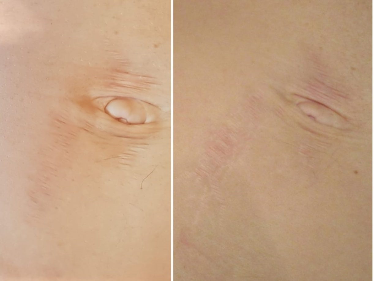Stretchmarks before and after microneedling