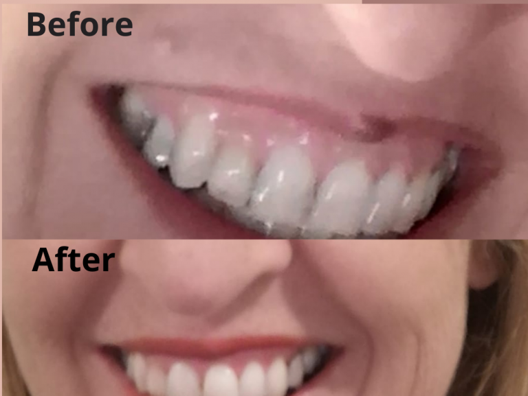 We remove a venous lake effectively Lasermed Laser Clinic & facial